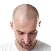 Scalp Micropigmentation