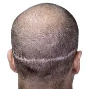 Scalp Scar Camouflage